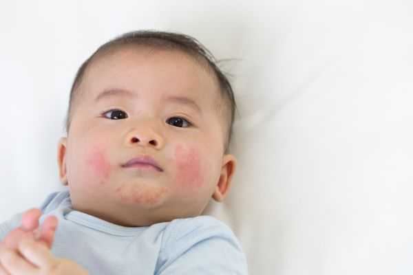 allergy signs in babies